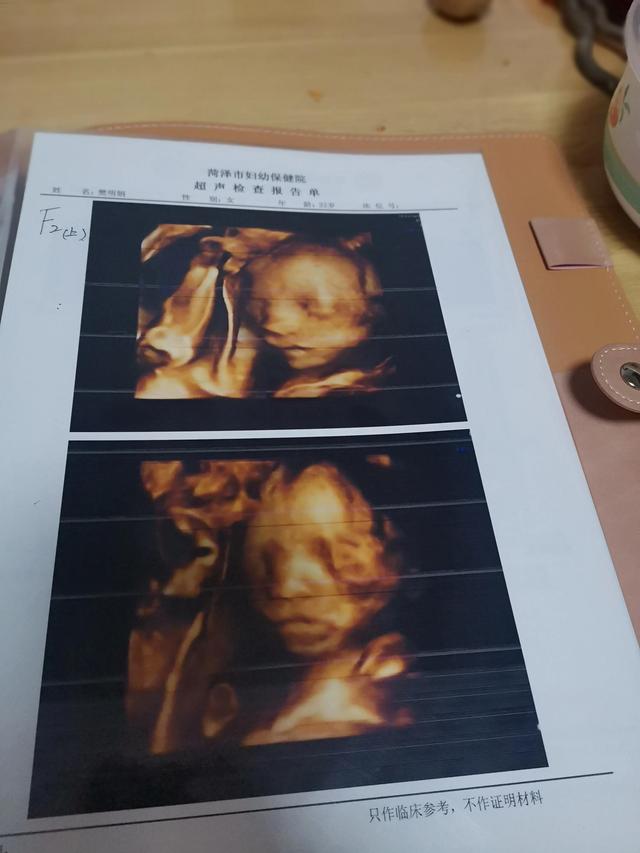 试管婴儿双胎 真期待两个小生命的降临