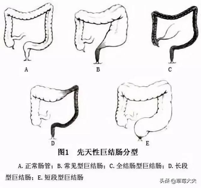 出生无肛门，肚子气球大！“气球宝宝”在草莓医院挺过来了