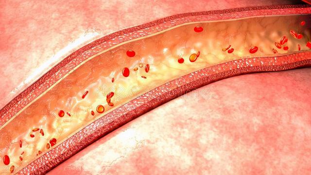 56岁大叔，每天吃洋葱降血脂，一个月后他的血脂有啥变化？