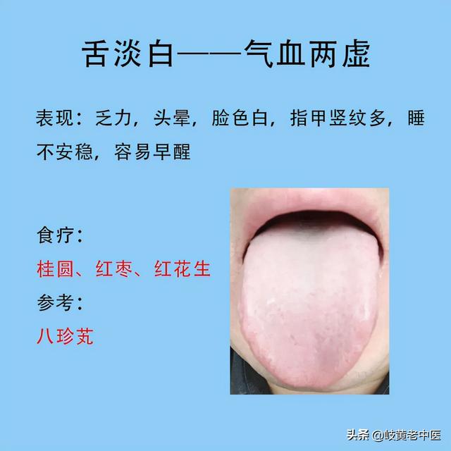 常见六种失眠的舌象，以及解决方法分享，这时候能睡个好觉了