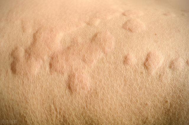 冬天常见皮肤问题的辨别治疗与预防