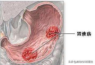胃溃疡患者大量喝牛奶有助胃溃疡修复？你的错误认知还要坚持多久