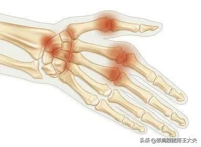 什么是痛风性关节炎？诊断依据是什么？这个方子可调