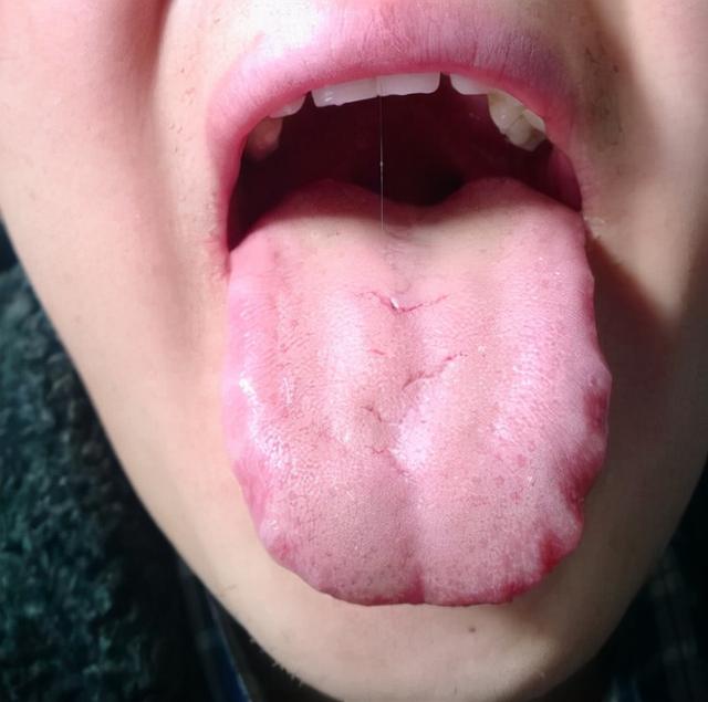 舌裂是什么原因造成的图片