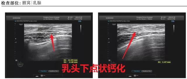 聯合檢查，讓乳腺導管原位癌無處可逃