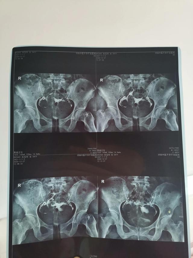 一位大龄妈妈为了要个二胎宝宝的心路历程