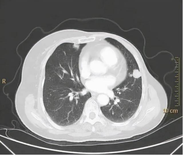 癌症患者极度消瘦？不是癌细胞抢夺营养那么简单！如何有效应对？