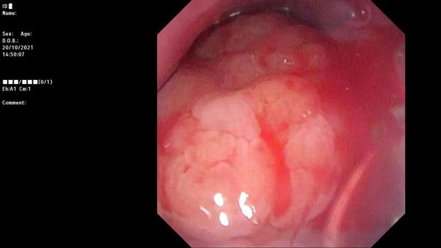 为一个罕见病患儿做手术