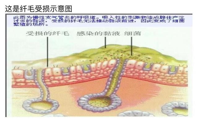 同样是咳嗽，为什么有的人是干咳，有的人咳嗽会大量吐痰呢？