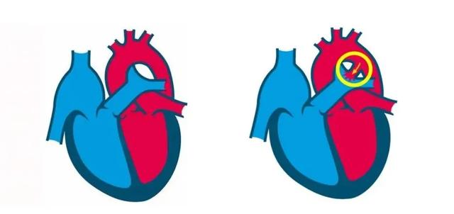 心脏是怎么长大的：第2篇——满是“漏洞”的心脏