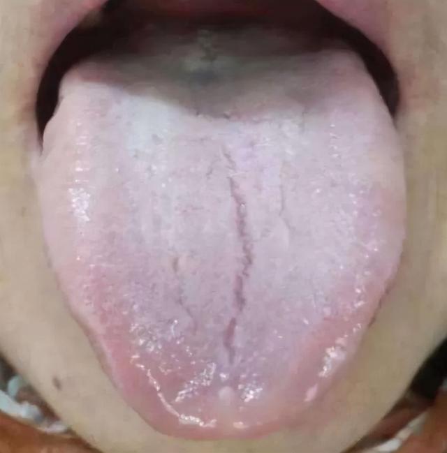 胃癌舌头症状图片图片