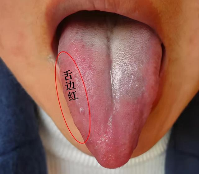 舌尖红心火旺，舌边红肝火旺，舌全红胃火旺，送你简单应对方法