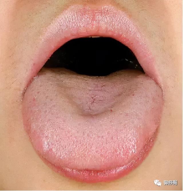 有多少脾虚，是因为肝郁？