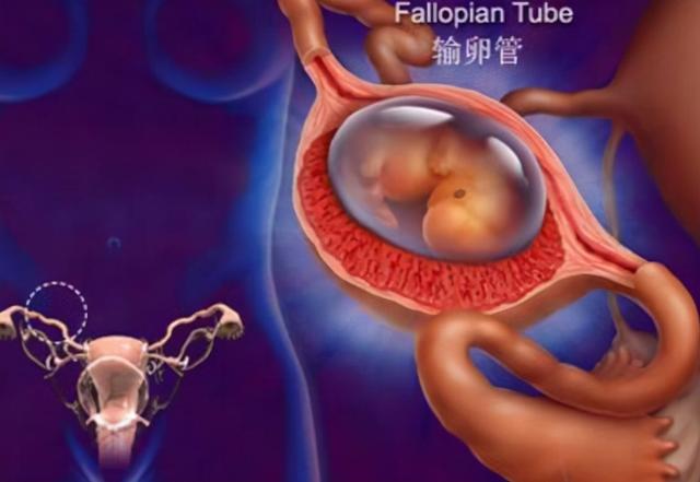 全球不足30例！广西一女子怀孕，胎儿却长在肝脏里，能生下来吗？