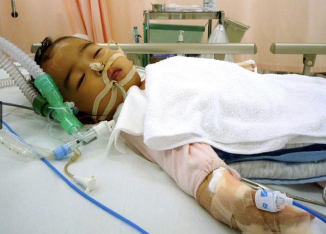 日本一岁八个月的孩子患脑肿瘤，开颅手术！失去声音「连载1」