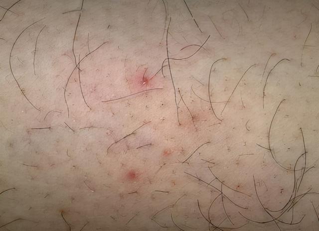 毛囊发炎是怎么回事？要忌口吗？