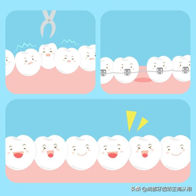 做牙齿矫正 为啥有些人既要拔牙 又要打骨钉 全网搜