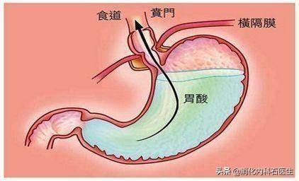 胃溃疡患者大量喝牛奶有助胃溃疡修复？你的错误认知还要坚持多久