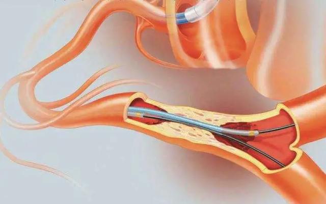 走路腿疼，走走又停停，警惕是这种病