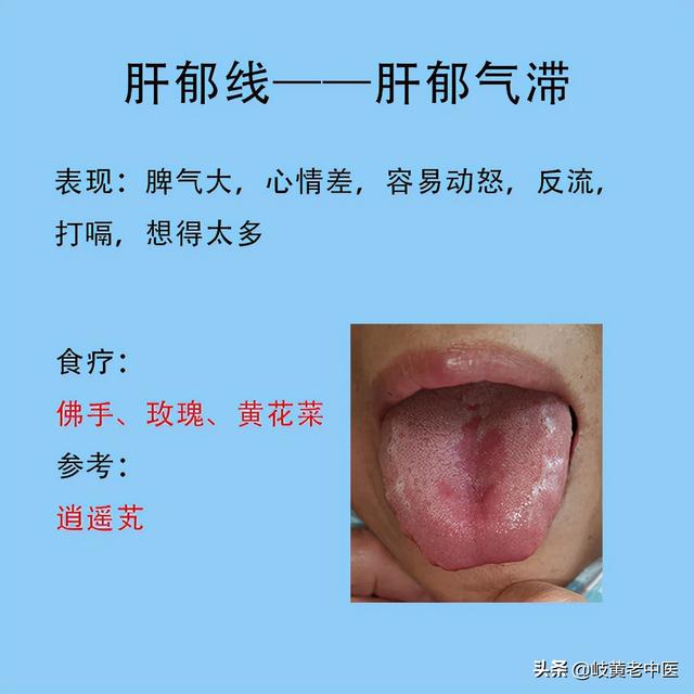 常见六种失眠的舌象，以及解决方法分享，这时候能睡个好觉了