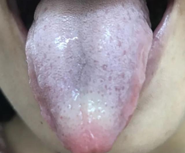 痰多难除？中医：善治痰者，不治痰而治气，用治气法扫除全身之痰