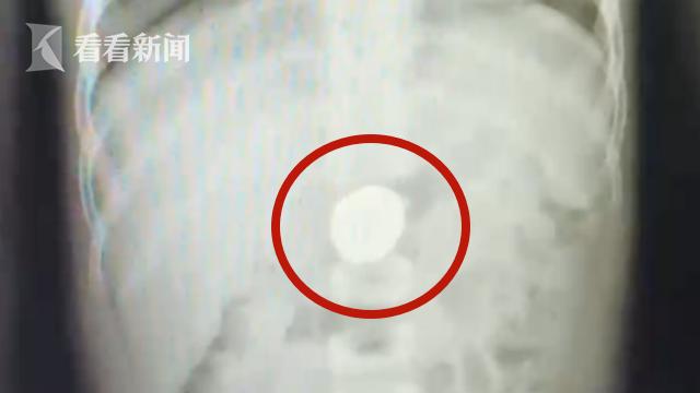 危险！6岁男童好奇吞硬币 卡在胃里一星期出不来