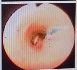 宝宝肺炎反复发作，一查，气管里竟有一个洞