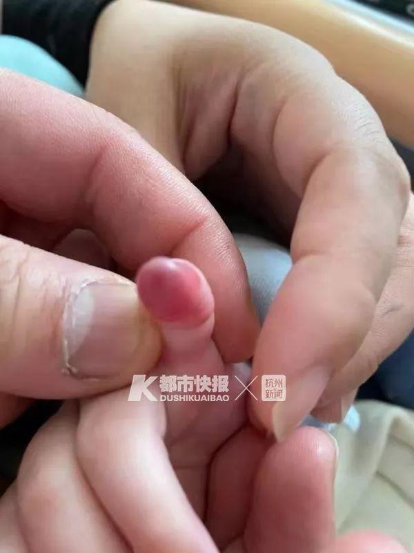 只因宝妈一个疏忽，新生1天婴儿差点截肢！爸妈注意，一根头发丝都可能导致意外