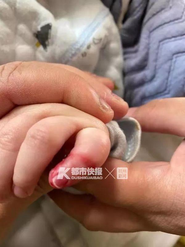 只因宝妈一个疏忽，新生1天婴儿差点截肢！爸妈注意，一根头发丝都可能导致意外