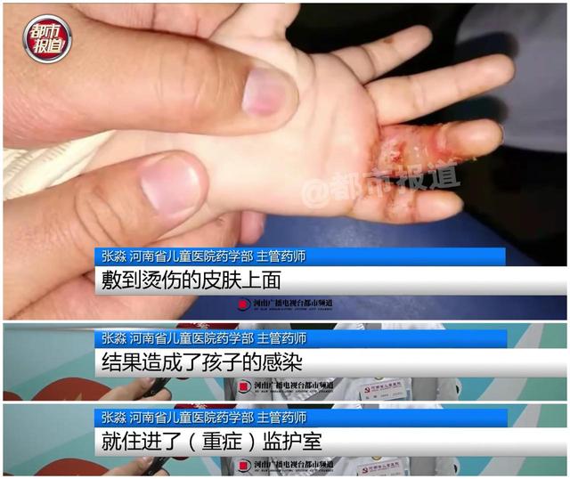 奶奶用老鼠熬油治孩子烫伤导致感染！这些偏方要人命