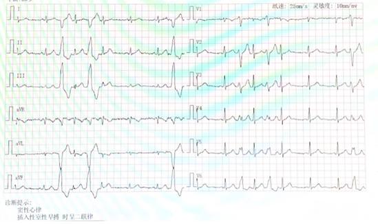 24小时5万多室性早搏，孕妈“疯狂心跳”怎么治？绿色消融术让心悸变心安