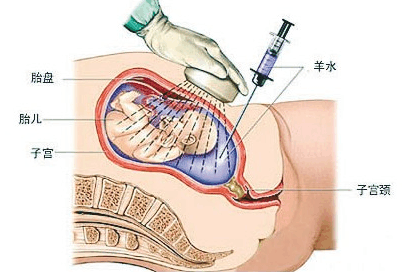 羊水穿刺能查出脑瘫吗 孕期如何预防小儿脑瘫