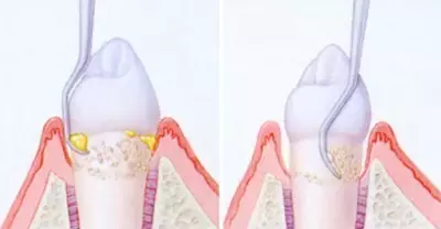 牙松了还有有救吗?是不是必须拔掉?