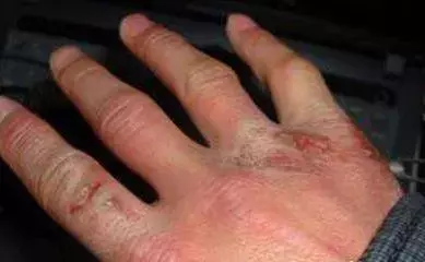 基层实用特效冻疮治疗方