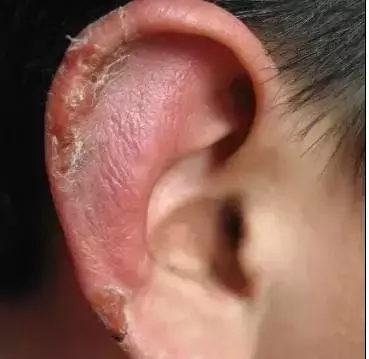 基层特效冻疮方,一学就会,一用就灵