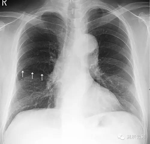 正位胸片常可以看到细线状的右肺水平裂,位于右肺野中部,自肺野边缘向