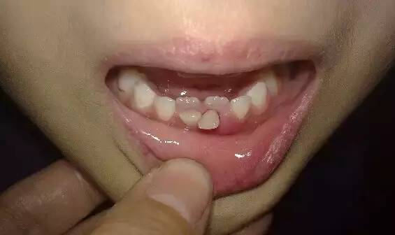可怕8岁男孩长了双排牙,严重还可能引起心肌炎,肾炎