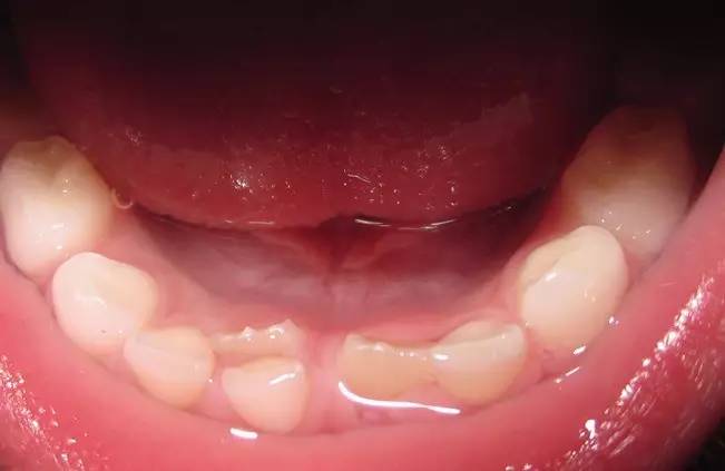 可怕8岁男孩长了双排牙,严重还可能引起心肌炎,肾炎罪魁祸首竟是这个