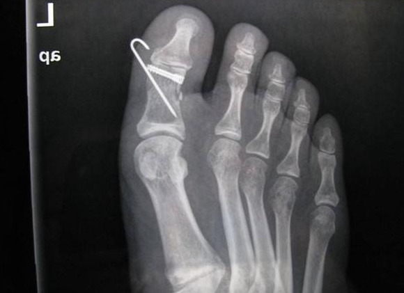 脚大拇指骨头受伤怎么养比较好「图文」