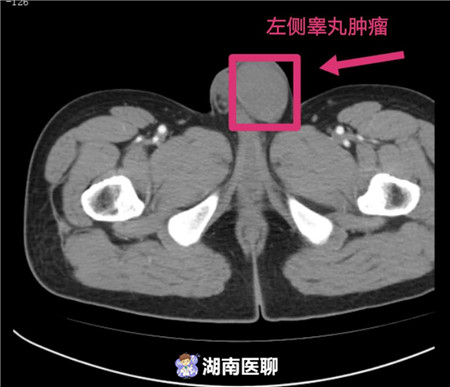 男子一侧“蛋蛋”肿胀，患上罕见睾丸癌！出现这些危险信号需警惕