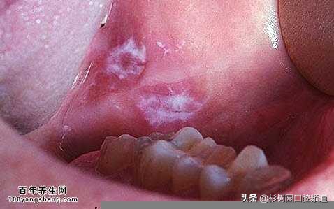 请不要误把口腔黏膜白斑当作口腔溃烂