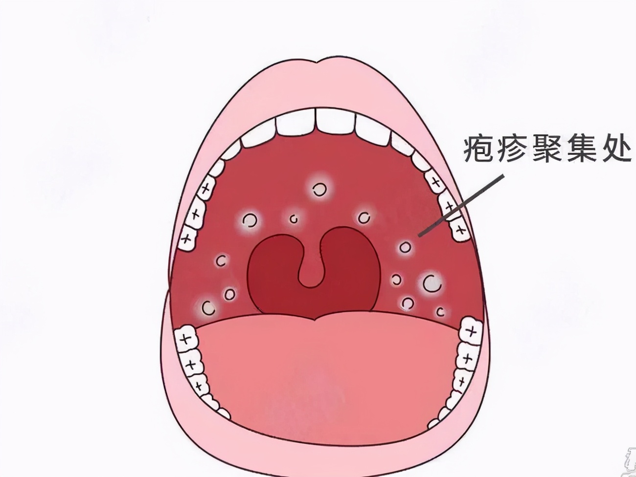 声带处喉粘液囊肿图片_有来医生