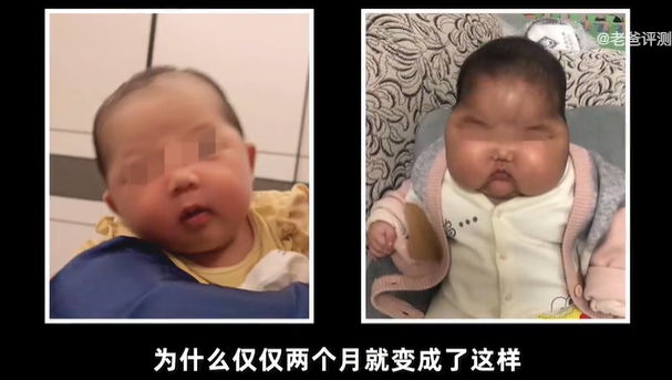 “大头宝宝”再现，疑似激素导致！如何避免“被迫性”激素滥用？