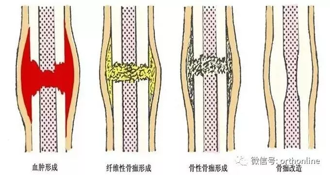 好文荐读：骨折的分类及愈合过程