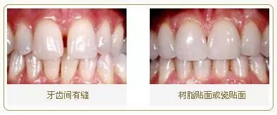 牙缝大，可以补吗？