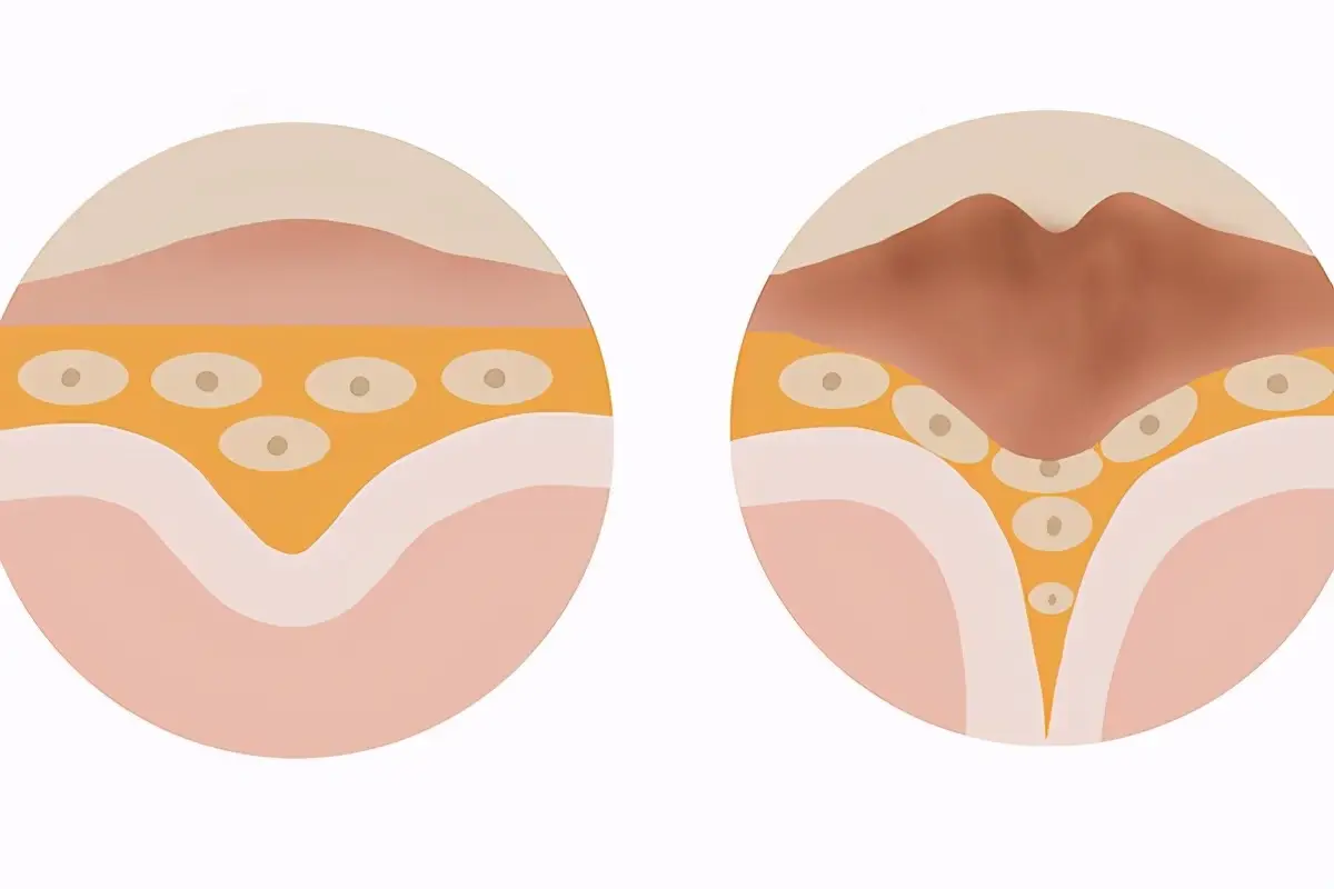 脚上长了***眼，有什么好方法能去除？***眼的原因有哪些？