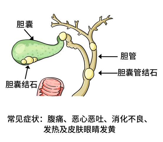 很多结石都是“吃”出来的！这些不良饮食习惯，你中招了吗？