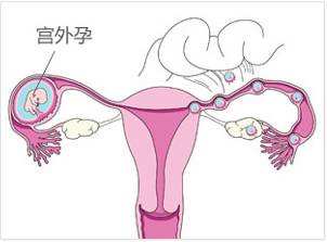 如果你是带环怀孕，这两个关键点一定要记住！