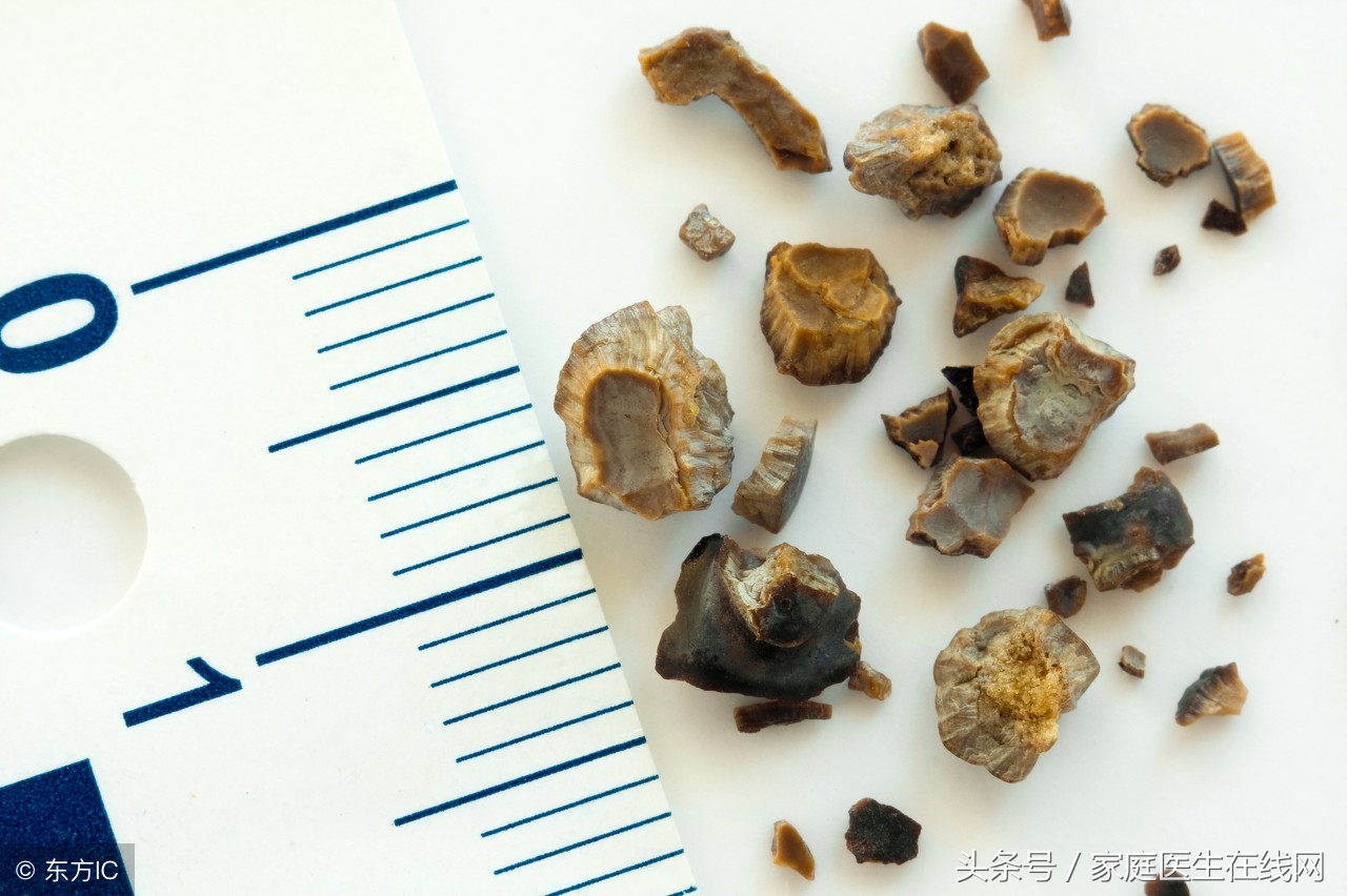胆结石如何有效排出与治疗方法
