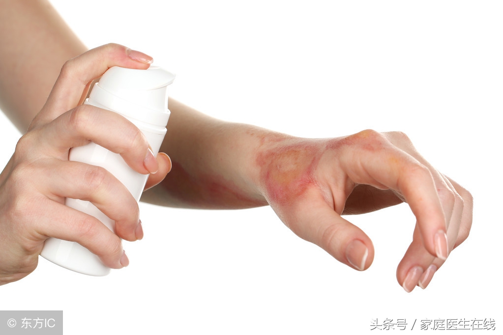 皮肤烫伤怎么办？紧急处理方法学起来，才能不留疤